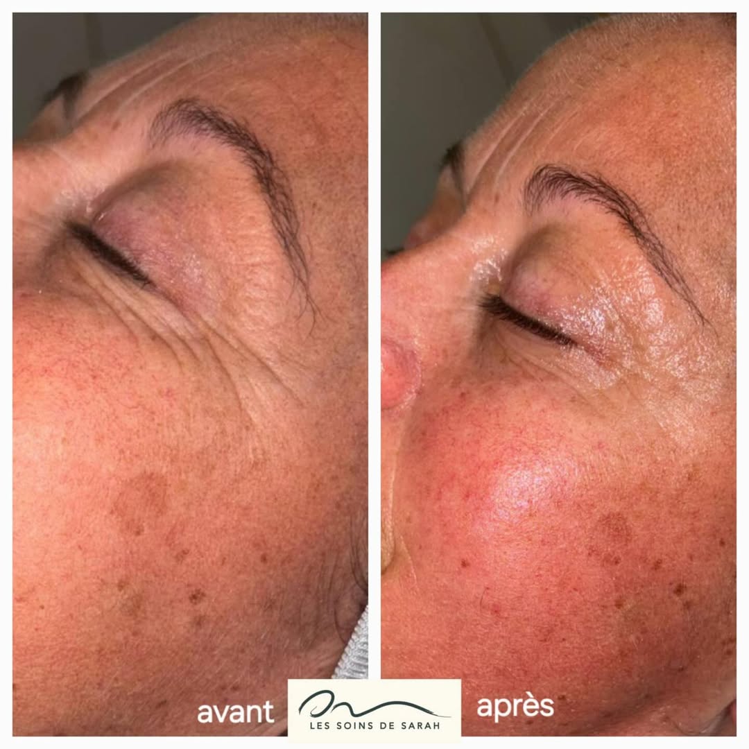 Résultat avant/après Miracle Face