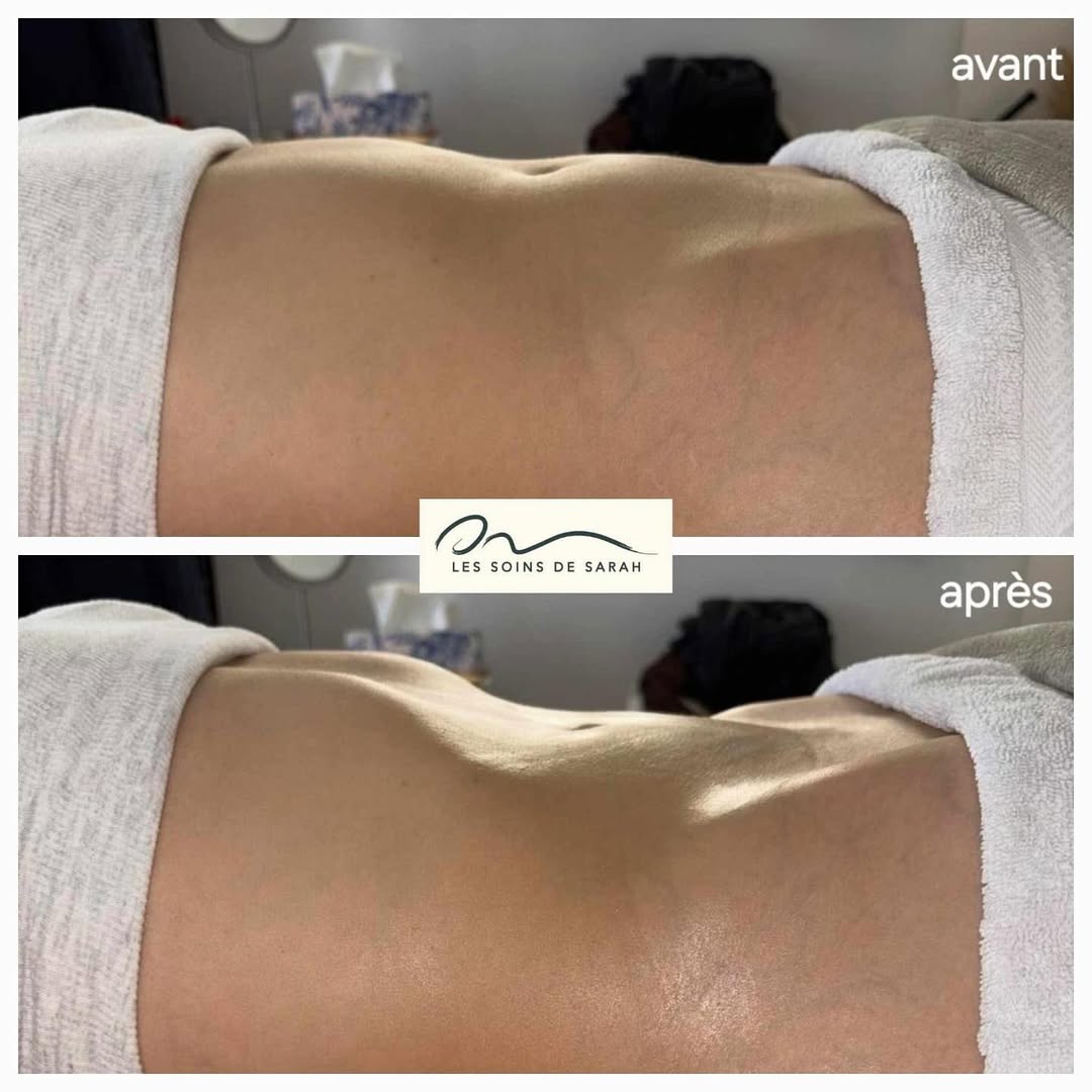 Résultat avant/après drainage lymphatique